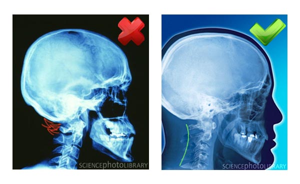 Röntgen képek: feszes és szabad nyak izmok (2 kép)